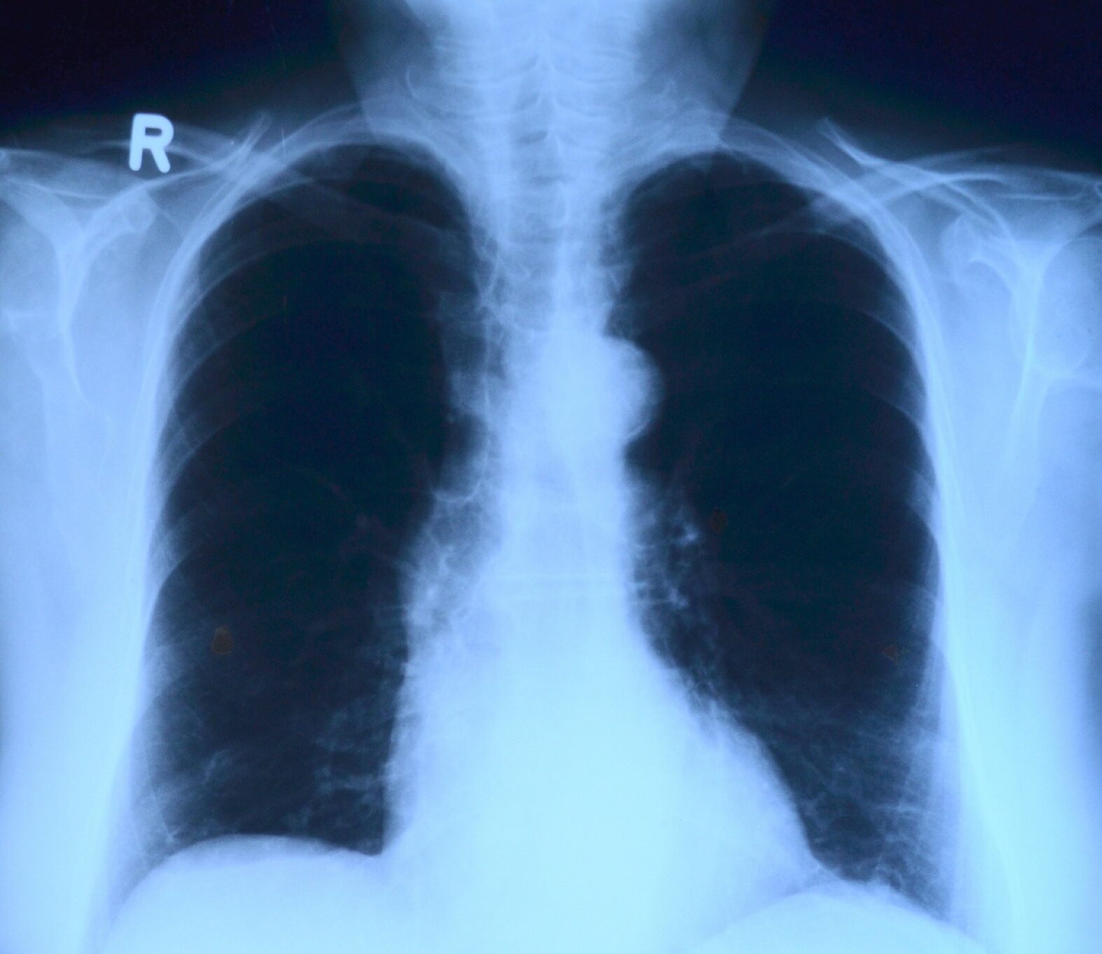 Radiografie a domicilio, l’esperienza di San Raffaele e Medicilio