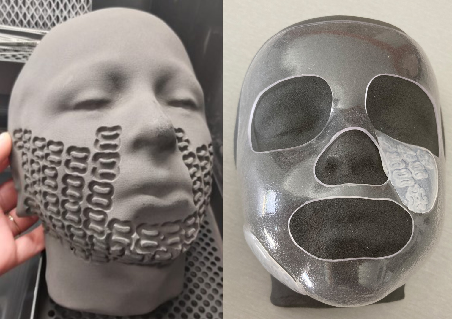 Ustioni pediatriche gravi: maschere facciali stampate in 3D